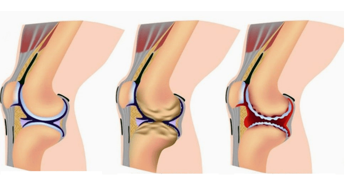 Difference between arthritis and arthrosis