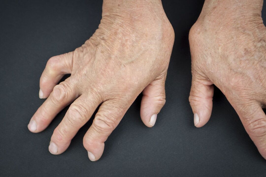 gout from his hands