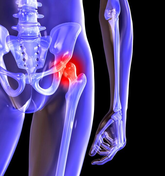 The hip joint deforming joint joint