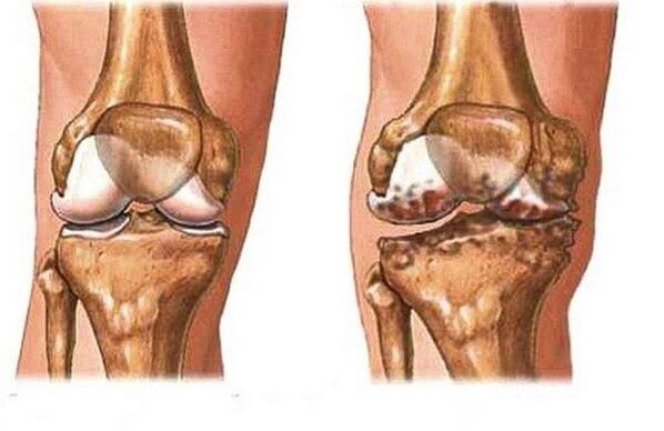 Healthy and sore joint