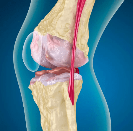 The arthrososis of the knee joint