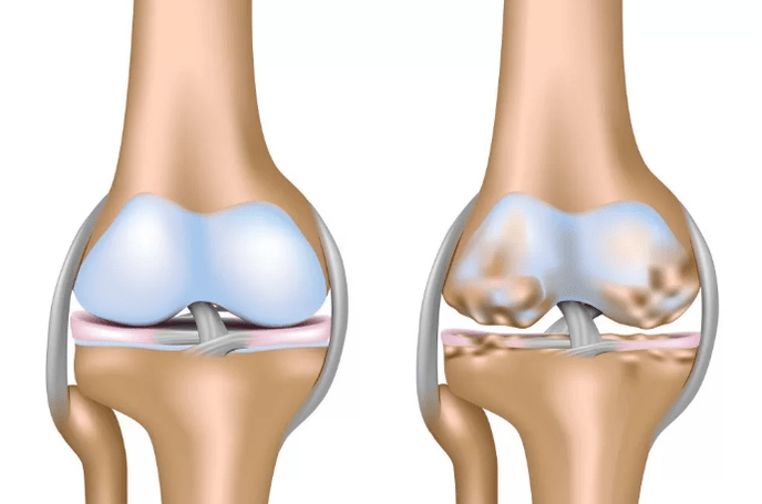 The knee joint deforming joint joint