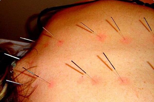 Acupuncture - a method of treating cervical osteochondrosis